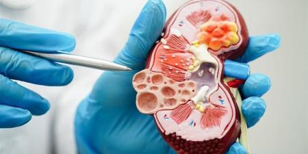 ارتفاع عالمي للإصابات بمرض قاتل يدخل ضمن أبرز 10 أسباب للوفيات - المصدر 7