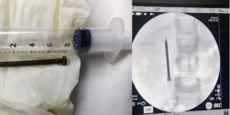 فريق طبي بجامعة المنوفية ينجح في استخراج مسمار حاد من أمعاء طفلة - المصدر 7