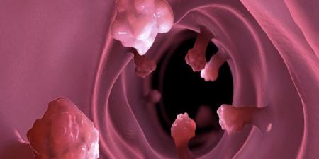 تحذير جديد.. الأطعمة فائقة المعالجة تعزز نمو الزوائد المعوية الممهّدة للسرطان - المصدر 7