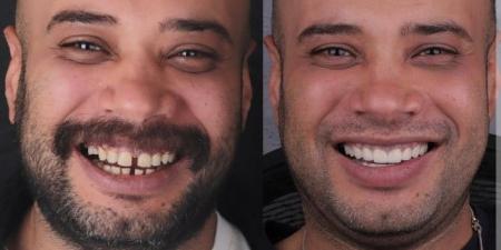 بعد أسابيع من الزواج.. حاتم صلاح يعدل فلقة أسنانه ويفاجئ الجمهور - المصدر 7