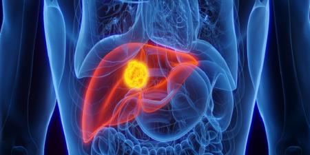 نهج واعد لمرضى سرطان الكبد المتقدم - المصدر 7