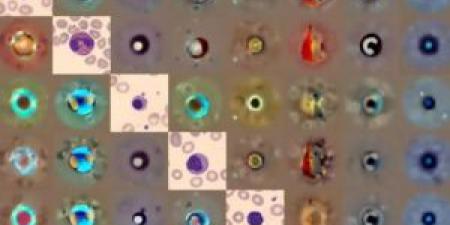 ذكاء اصطناعي يكتشف تشوهات خلايا الدم بدقة تتجاوز الأطباء - المصدر 7