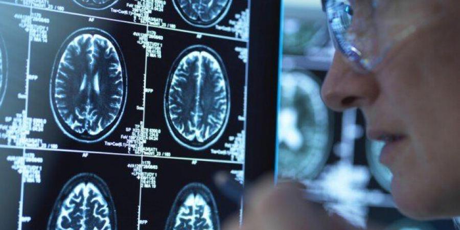 اكتشاف علمي يفتح آفاقاً جديدة لعلاج ألزهايمر باستخدام مادة طبيعية في الجسم - المصدر 7