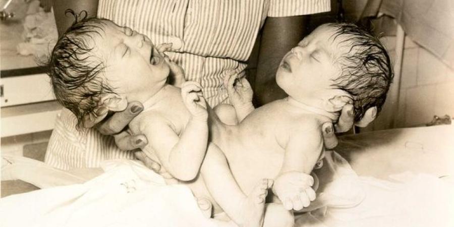 أغرب حالات التوأم المتطابق التي حيّرت الطبّ - المصدر 7