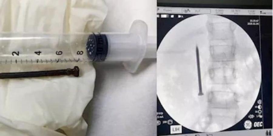 فريق طبي بجامعة المنوفية ينجح في استخراج مسمار حاد من أمعاء طفلة - المصدر 7